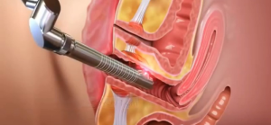 content_content_femilift_video_grab_0115