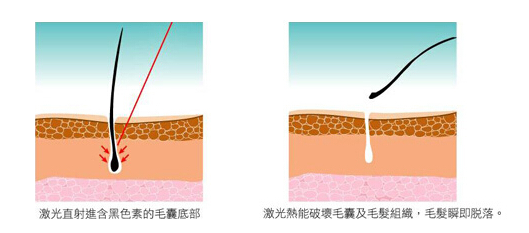 脫毛療程